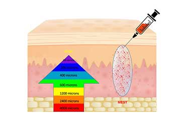 Skin layers beside a micron ladder from 400 to 4000 microns, relating graft size to depth